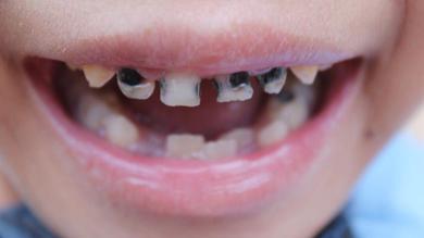 Yuk Ketahui Penyebab Gigi Gigis Pada Anak!