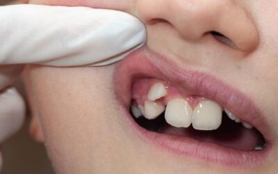 Anak Mengalami Gigi Mesiodens? Kapan Harus Konsultasi?