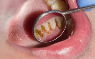 Yuk Kenali Efek Dari Adanya Karang Gigi!