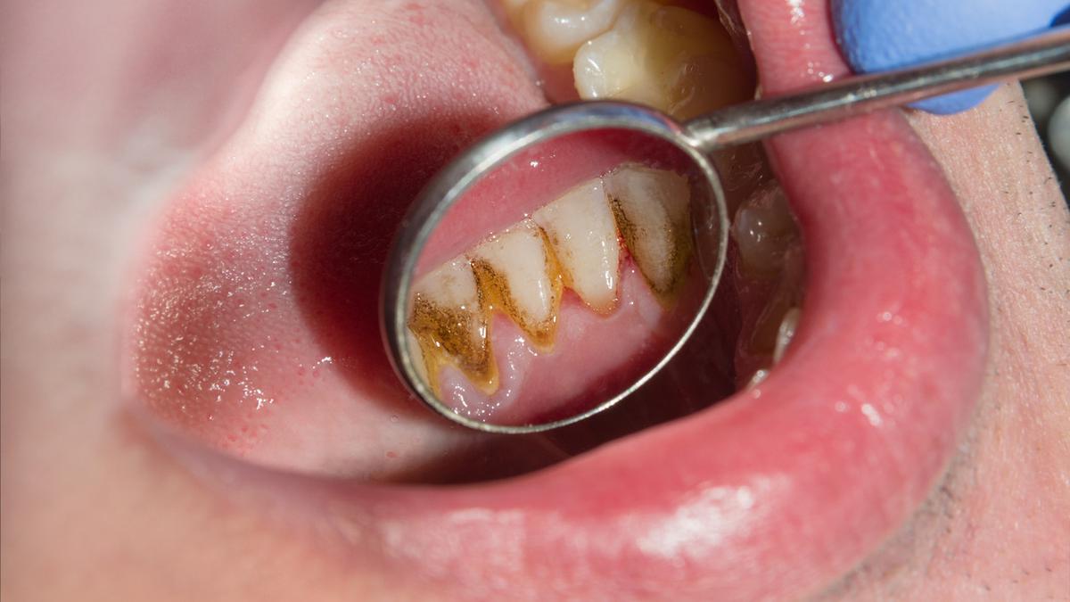Yuk Kenali Efek Dari Adanya Karang Gigi! Ester Dental (Klinik Gigi Solo) Yuk Kenali Efek Dari Adanya Karang Gigi! Ester Dental (Klinik Gigi Solo)