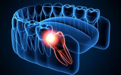Gigi Geraham Bungsu Tumbuh? Apa Bahayanya?