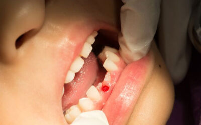 Gigi Nyeri Akibat Terkena Benturan? Bagaimana Menangani Trauma Pada Gigi?