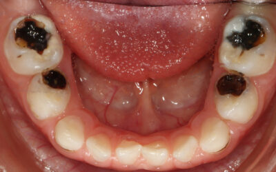 Atasi Karang Gigi Anak Dengan Silver Diamina Flouride (SDF)!