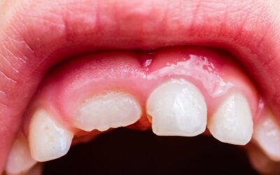 Gusi Bengkak, Apa Penyebabnya?