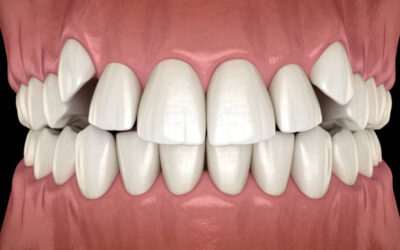 Bagaimana Merawat Gigi Taring Agar Tetap Kuat?