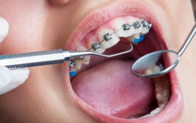 Apa Saja Hal Penting Sebelum Pemasangan Behel Gigi?