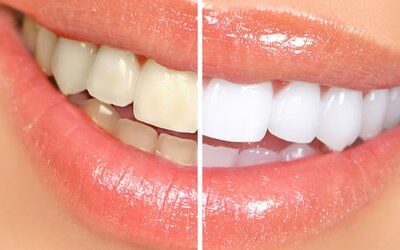 Gimana Sih Caranya Biar Tidak Terjebak Mitos Pemutihan Gigi?
