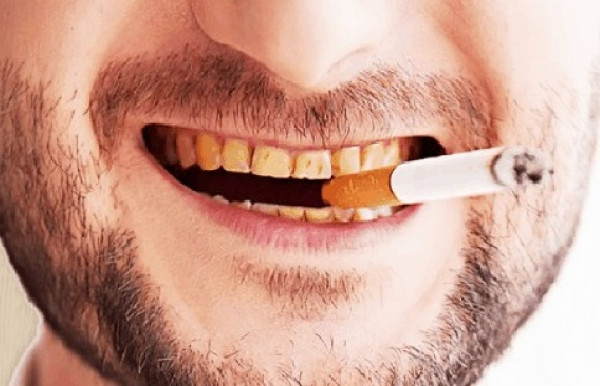 Stop Rokok Untuk Cegah Gigi Kuning Kamu!