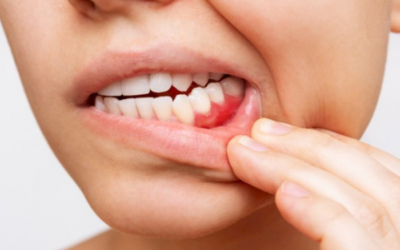 Gusi Bengkak? Bagaimana Mengatasinya?