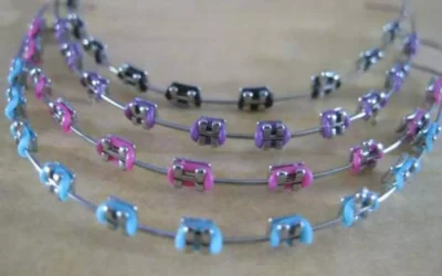 Apakah Behel Gigi Bisa Berkarat?