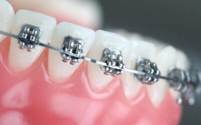 Berikut Ini Merupakan Cara Menjaga Bracket (Behel Gigi) Kamu Agar Tetap Bersih!