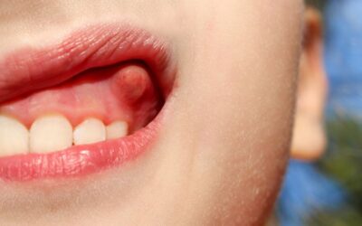 Kenali Berbagai Macam Penyakit Gusi!