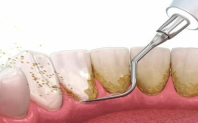 Gigi Kamu Mulai Tumbuh Karang? Saatnya Melakukan Scalling Di Ester Dental!
