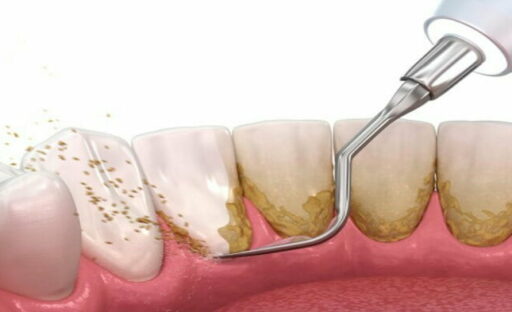 Gigi Kamu Mulai Tumbuh Karang? Saatnya Melakukan Scalling Di Ester Dental!