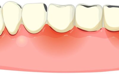 Mengapa Gusi Berdarah? Yuk, Kenali Penyebabnya dan Cara Mengatasinya!