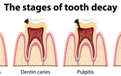 Gusi Bengkak dan Berdarah? Waspada Periodontitis