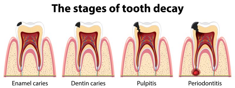 Gusi Bengkak dan Berdarah? Waspada Periodontitis