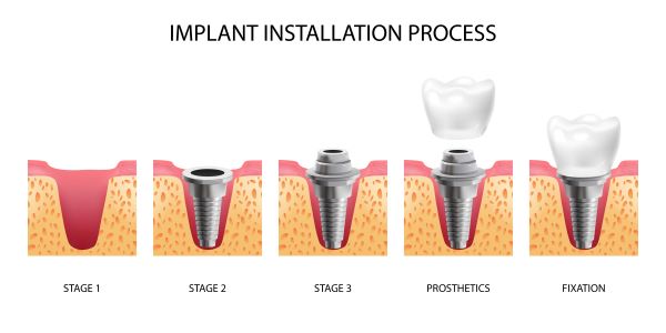 Proses Implant Gigi: Dari Pembedahan hingga Senyum Baru
