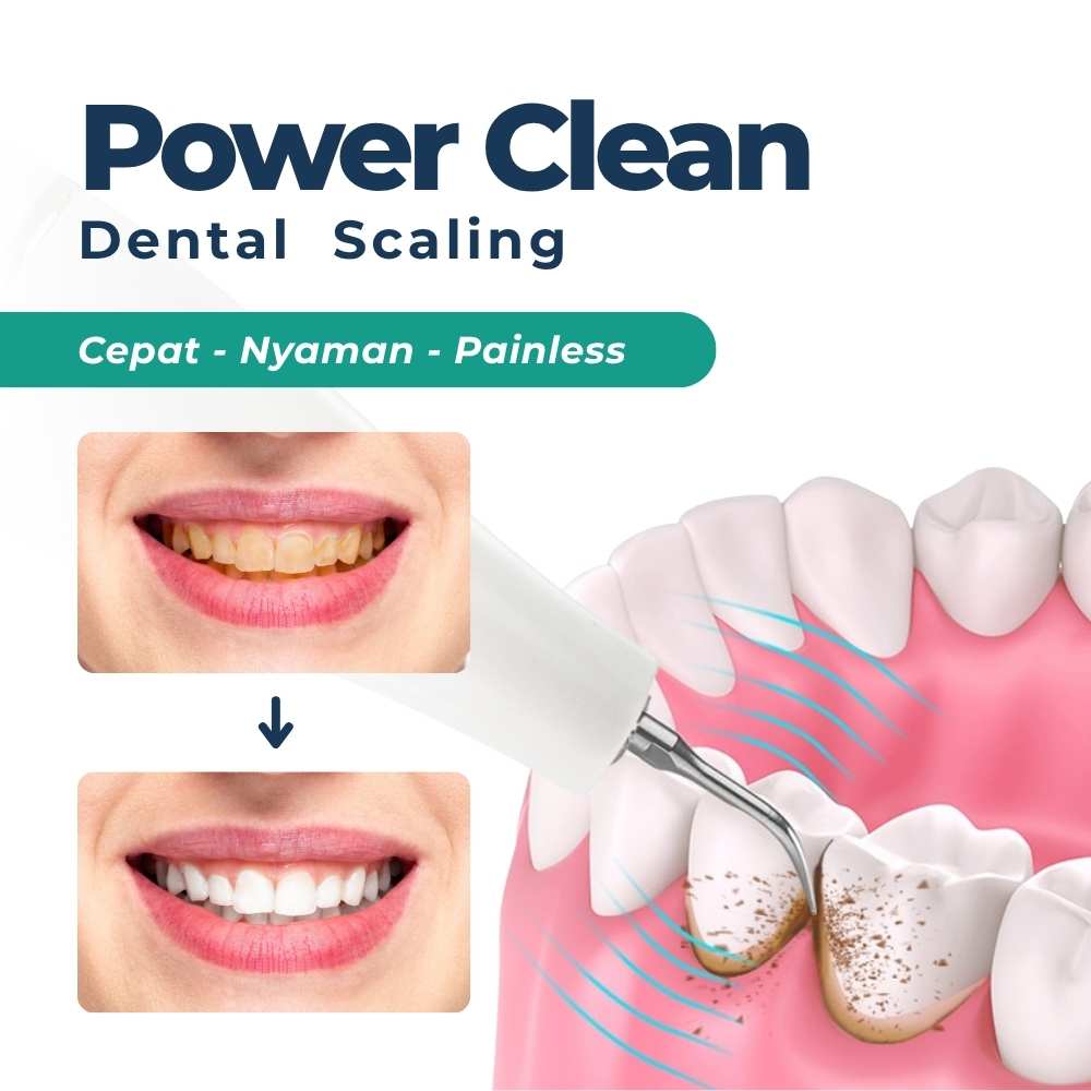 Power Clean Scaling & Polishing 