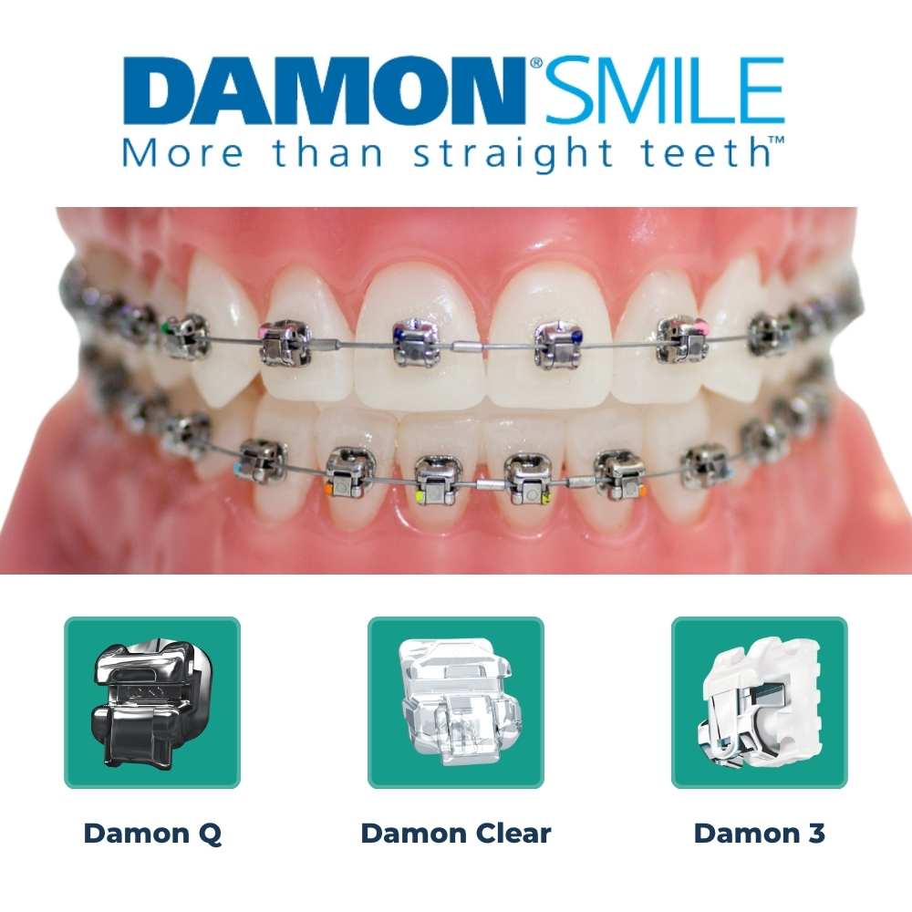  DAMON System Dental Braces 