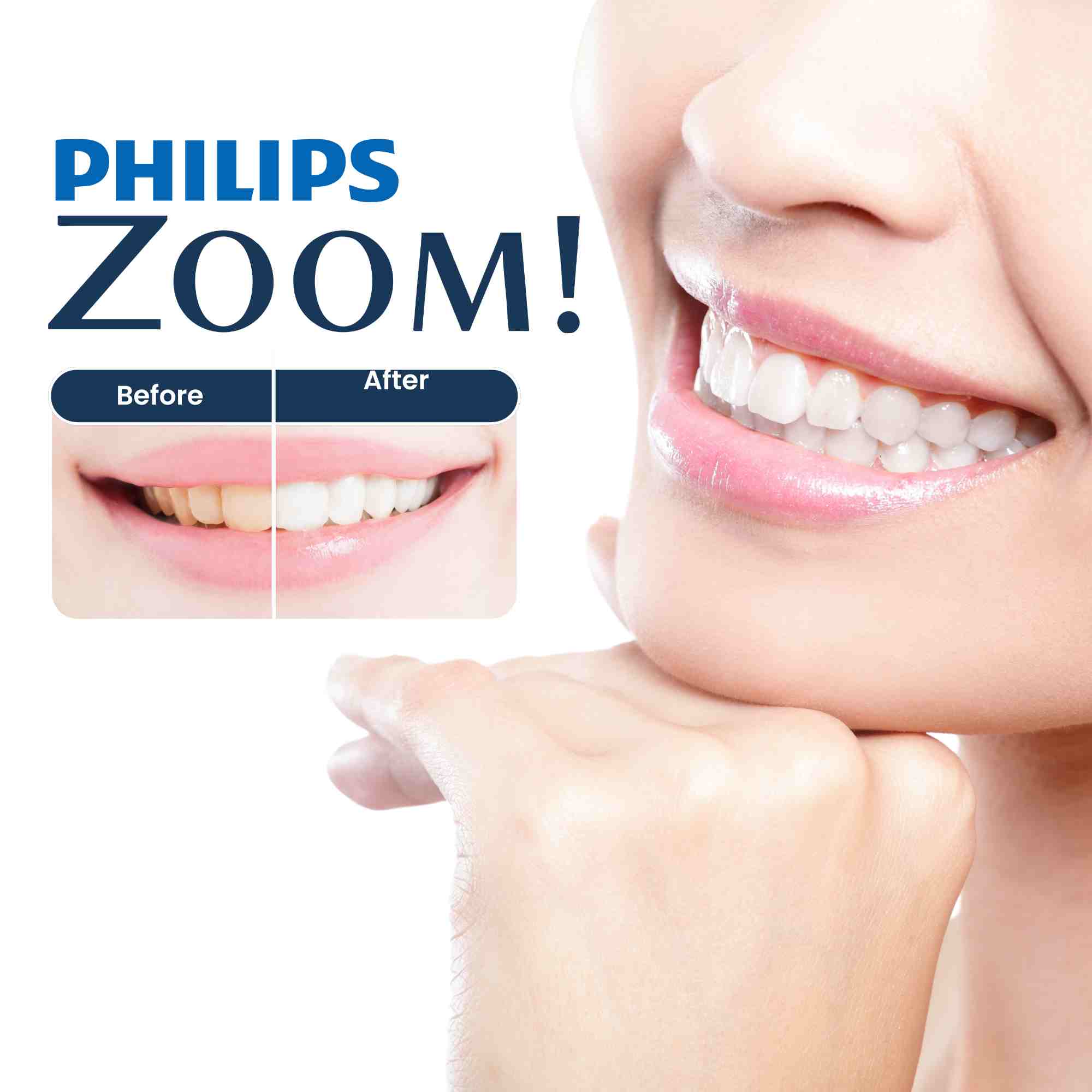  Philips Zoom Teeth Whitening 